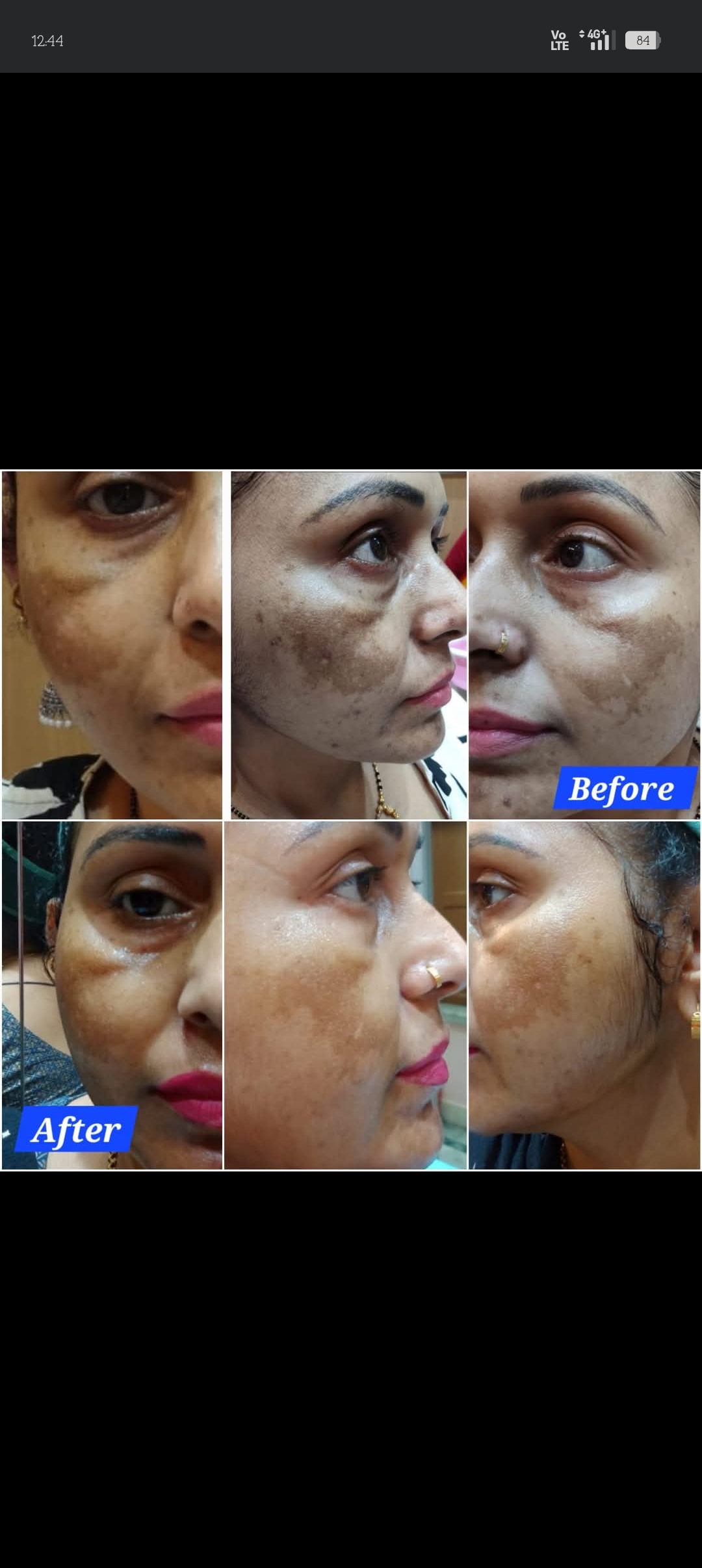 Melasma Treatment 