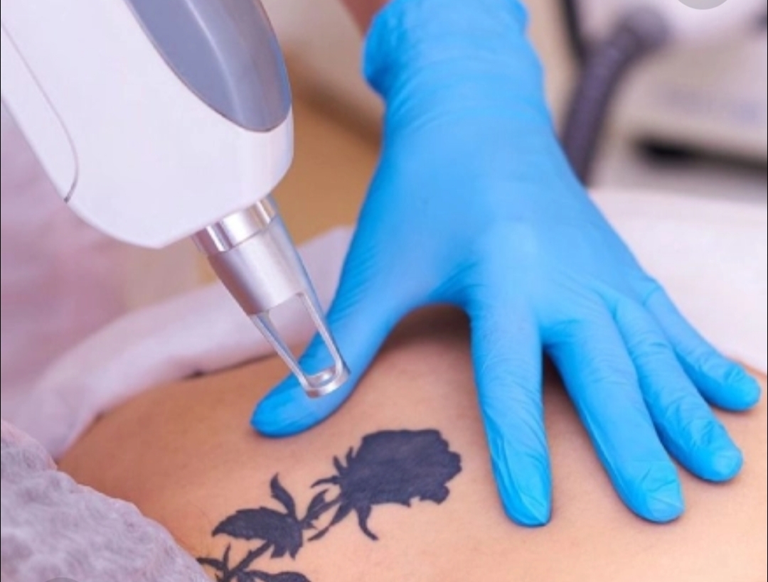 Tatto Removal 
