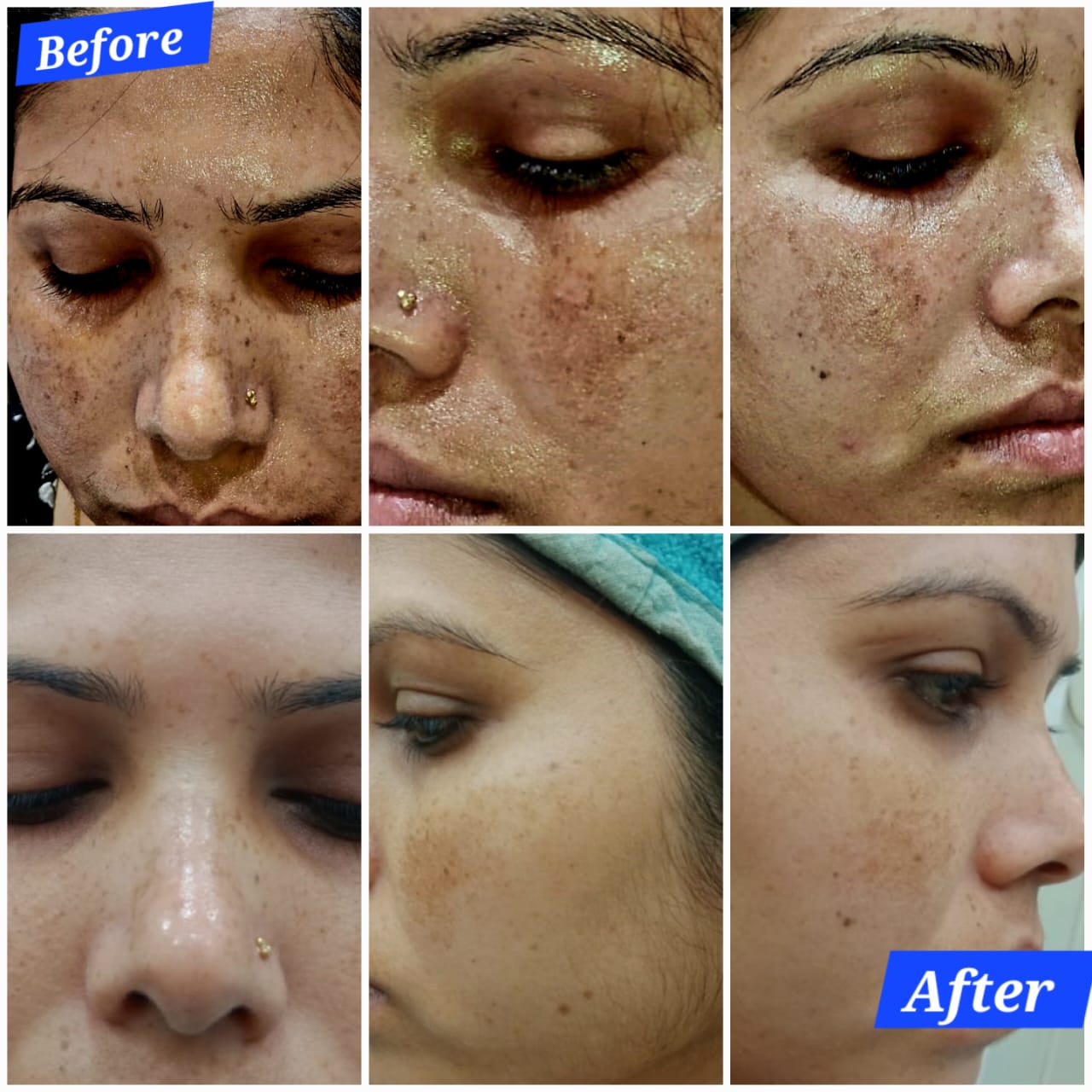 ACNE SCARS TREATMENT 