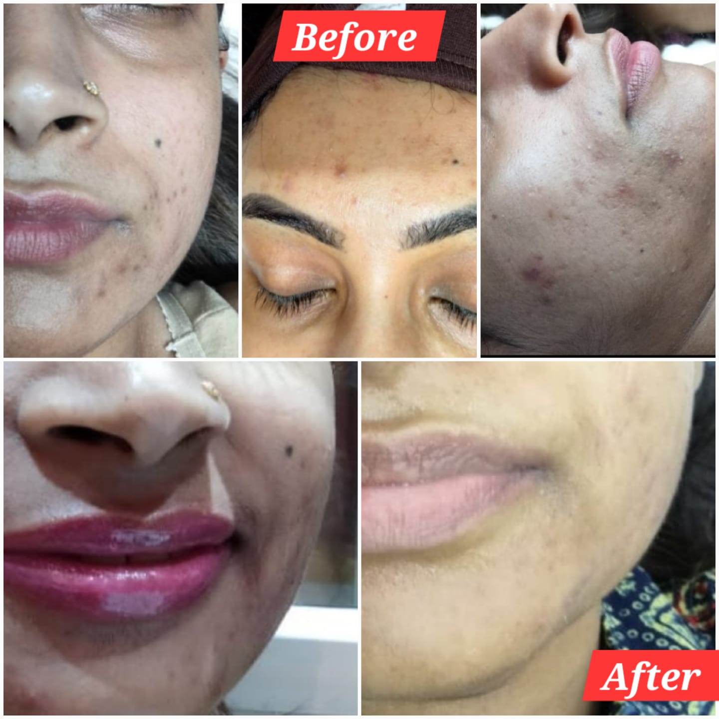 LIP FILLER TREATMENT 