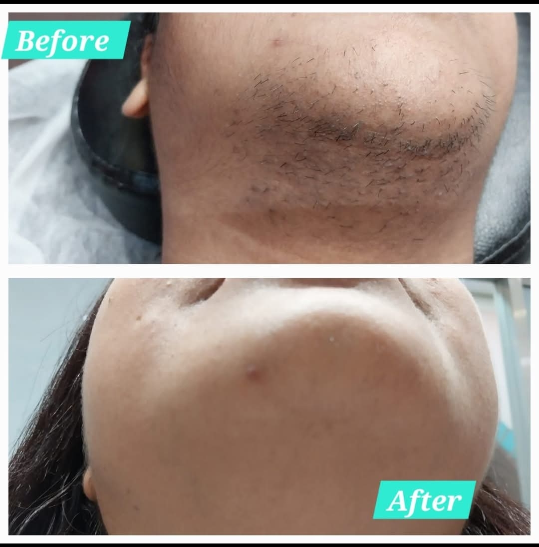 PERMANENT FACIAL HAIR REDUCTION 