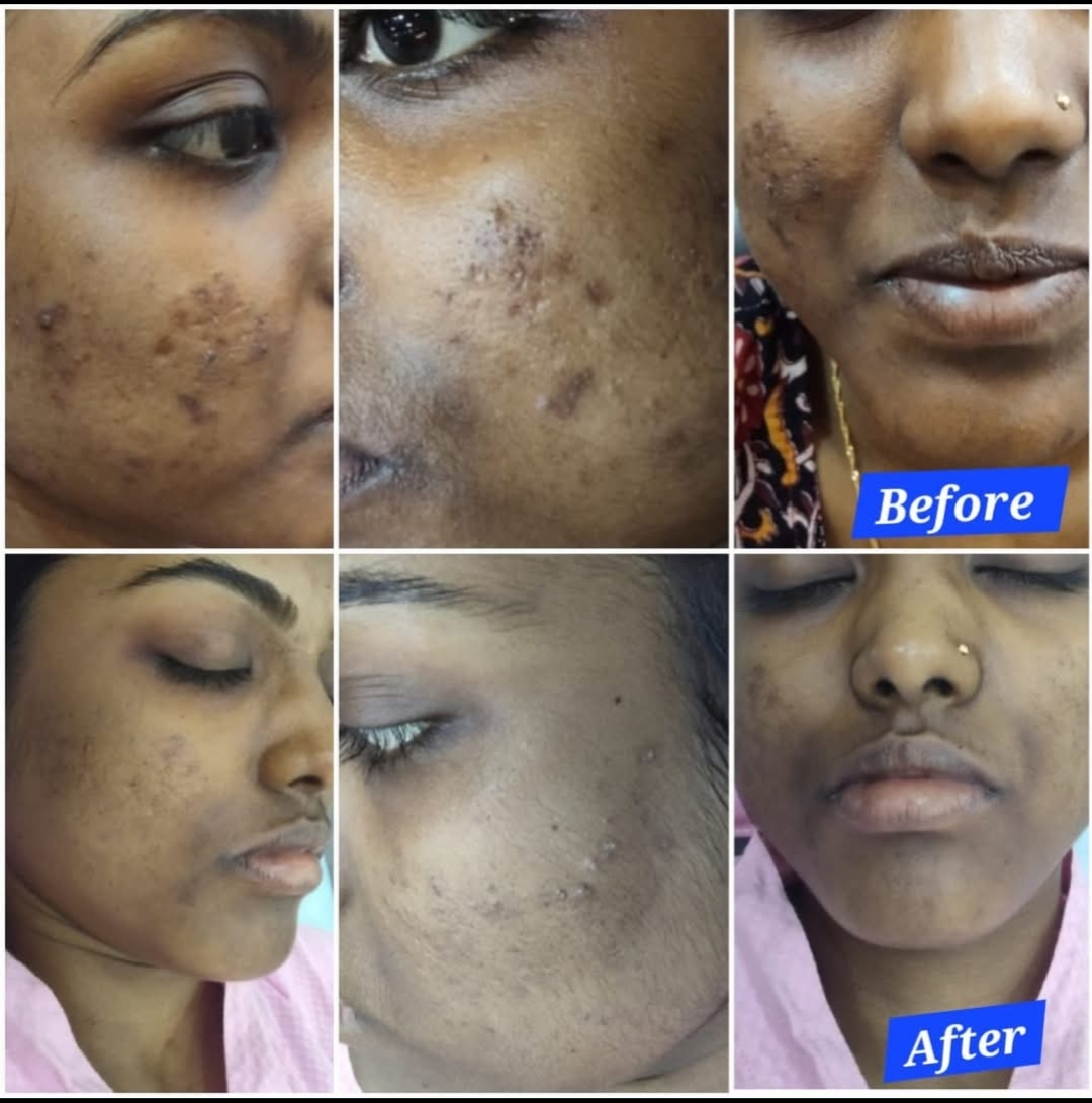 CYSTIC ACNE TREATMENT 