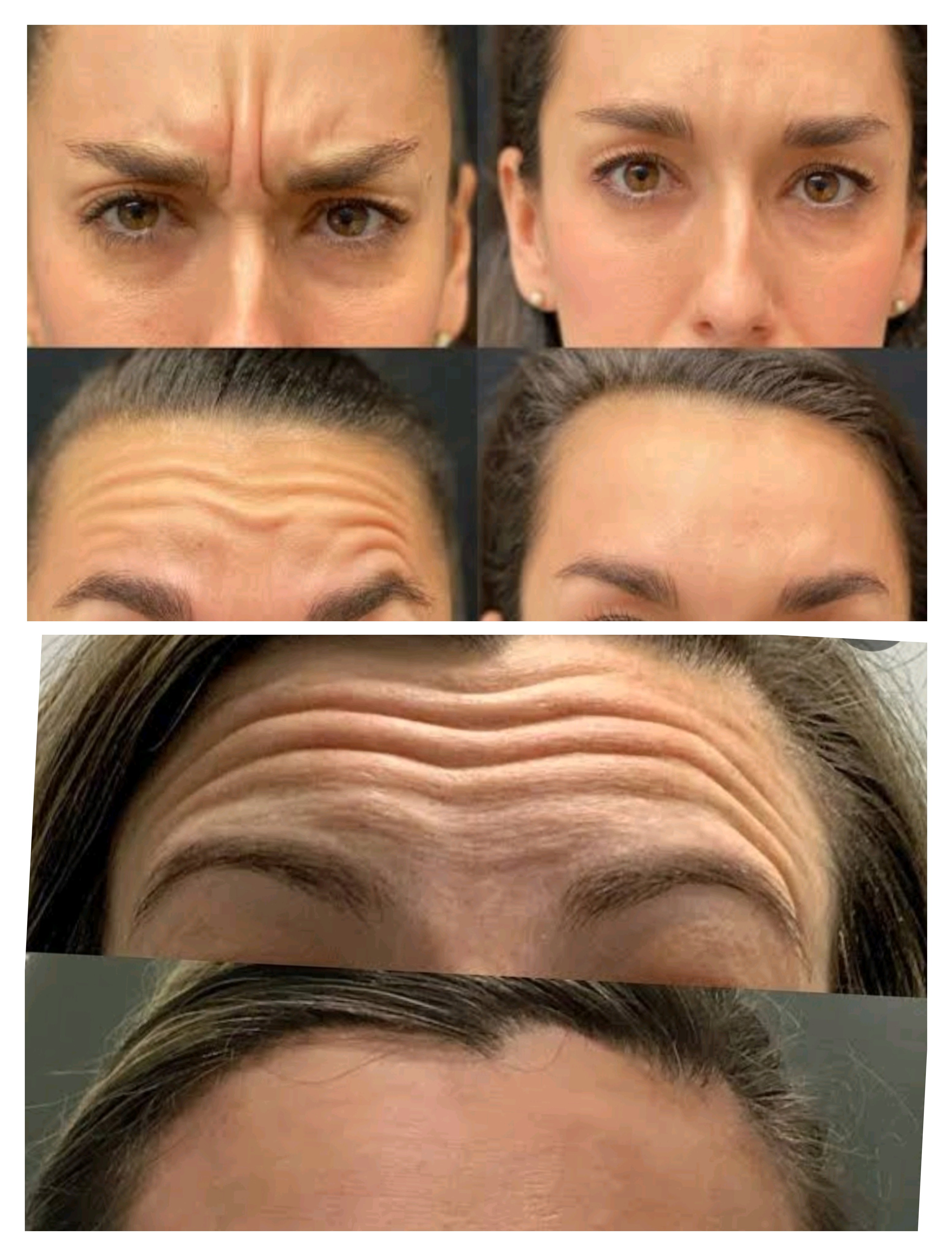BOTOX TREATMENT 